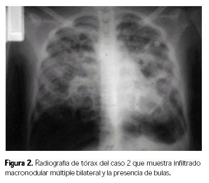 Reporte De Cinco Casos Pedi Tricos De Histoplasmosis Diseminada