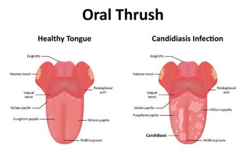 Yeast infection in Mouth: Oral Thrush, Causes, Remedies - Healtreatcure