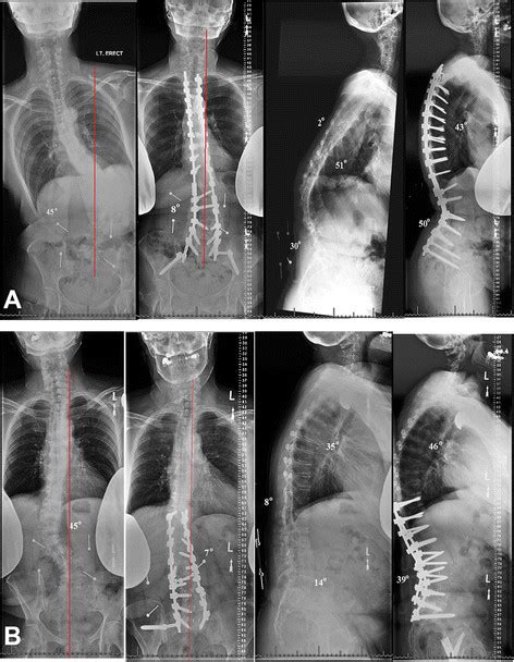 Two 63 And 79 Year Old Women Suffering From Adult Spinal Deformity