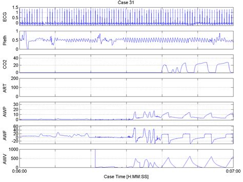 Case 31 Waveform Plots 60 Second Plots