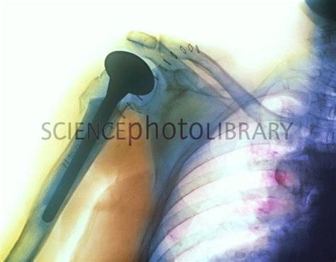 Shoulder Prosthesis Human Body Bone Diseases Radiography