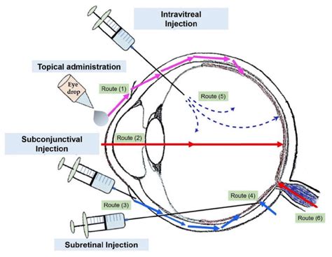 Common Drug Administration Routes Through The Eye Topical