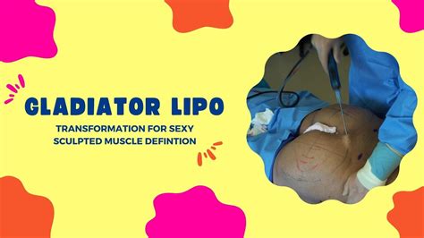 GLADIATOR LIPO TRANSFORMATION FOR SEXY SCULPTED MUSCLE DEFINTION