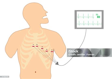 Ecg 12lead Precordial Lead Placement Electrocardiography Monitoring