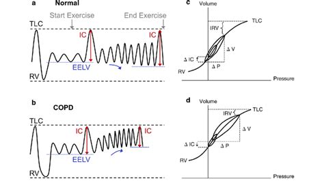 Change In Eelv Ic And Irv During Exercise In A Normal Lungs And B