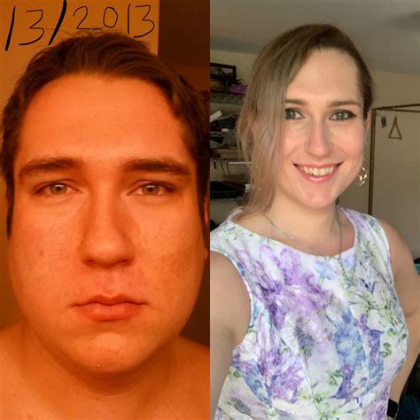 31yo 4 Years Pre 18 Months Hrt R Transtimelines