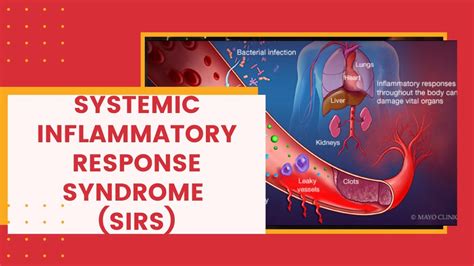 Systemic Inflammatory Response Syndrome Sirs Youtube