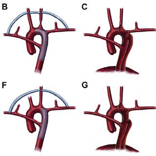 Graft Replacement Kommerells Diverticulum And In Situ Aberrant