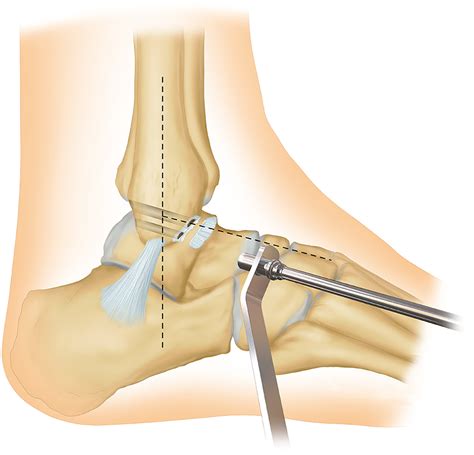 Anatomic Reconstruction Of Anterior Talofibular Ligament With Tibial