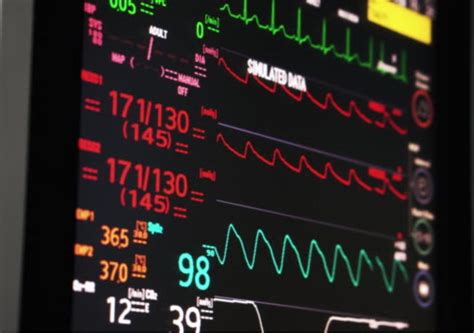 The Vitals: Indications for Arterial Line Placement – CriticalCareNow