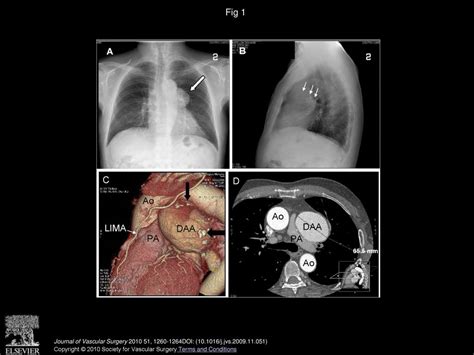 Incidental Detection Of A Giant Ductus Arteriosus Aneurysm By Low Dose