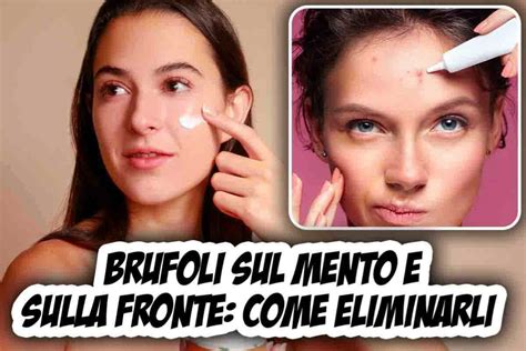 Brufoli Sul Mento E Sulla Fronte Perch Compaiono E Come Eliminarli