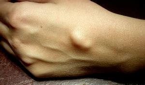 Are Hand Tumors Dangerous?