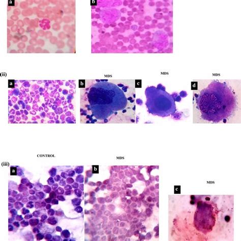 Peripheral Blood And Bone Marrow Leishman Staining Of The Peripheral