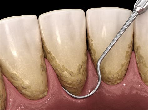 Scaling Root Planing North Dallas Dental Health