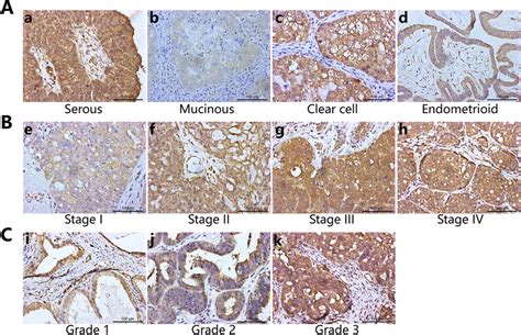 Immunohistochemical Ihc Staining Of Ovarian Cancer Tissues With