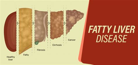 Grade 2 Fatty Liver Symptoms Risks And Treatment Options PlanMyMedical