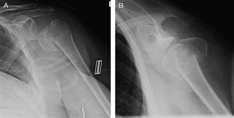 Calcium Phosphate Cement Augmentation Of Proximal Humerus Fr