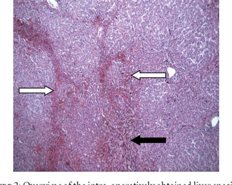 Nodular Regenerative Hyperplasia