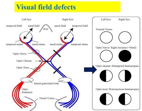 Visual Field Defects Chart Optic Nerve Chiasm Radiation Cranial Nerves