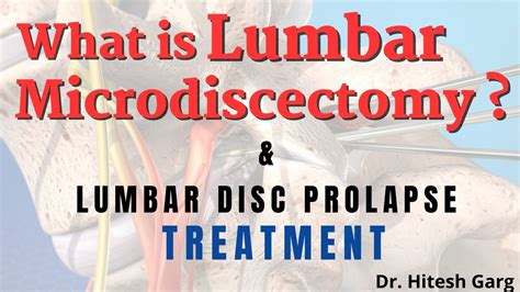 What Is Lumbar Microdiscectomy Lumbar Disc Prolapse Treatment For