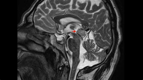 Pineal Gland Mri