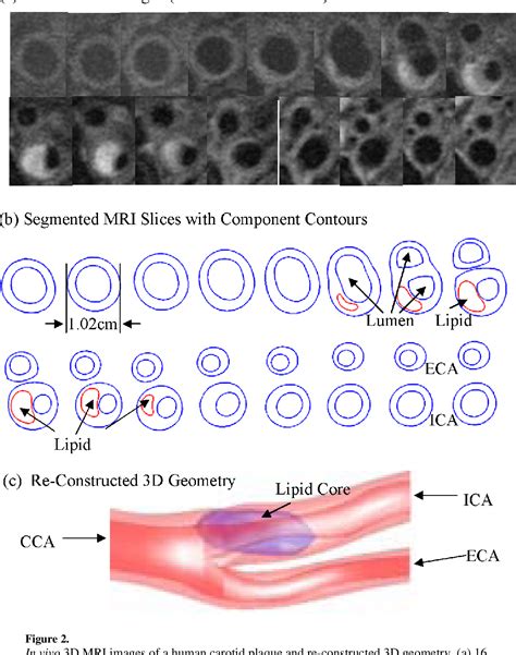 Figure 2 From Patient Specific Artery Shrinkage And 3D Zero Stress