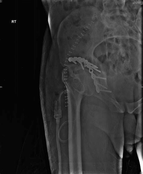 Acetabular Reconstruction