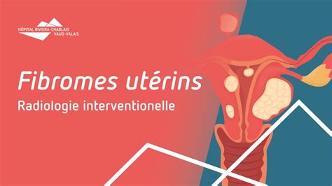 Les Fibromes Ut Rins Et Leur Traitement Par Embolisation Youtube