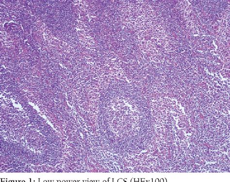 Figure 1 From Langerhans Cell Sarcoma Of The Axillary Lymph Node A