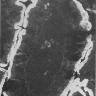 Figure A Photomicrograph X 10 Of Duodenal Mucosal Biopsy 3 Cm Distal