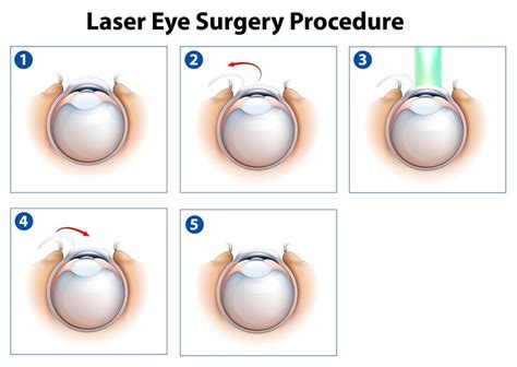 LASIK Vs LASEK Vs PRK Laser Eye Surgery Hub