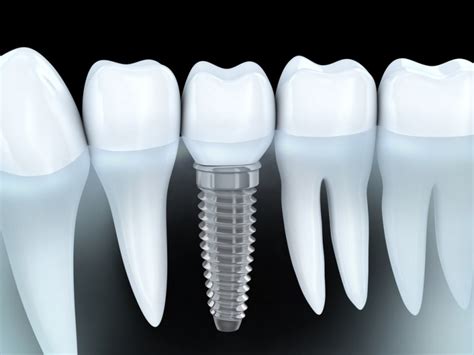 Dental Implants Dallas Tx Find Dental Implants Dentists