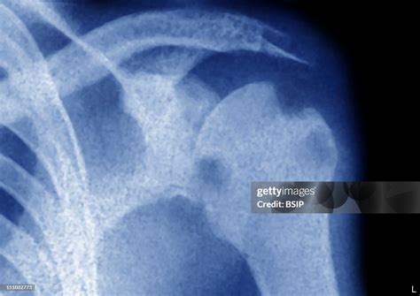 Bone Tuberculosis Of The Humerus Head X Ray Of The Left Shoulder In ...