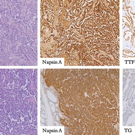 The Key To Distinguishing Between Primary Thyroid Papillary Carcinoma Download Scientific