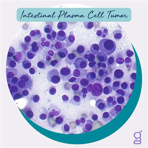 Plasma Cell Tumors In The Gi Tract