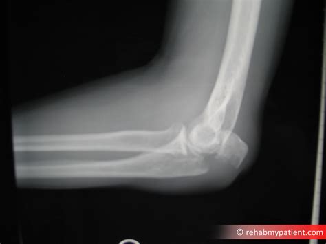 Elbow Olecranon Fracture Rehab My Patient