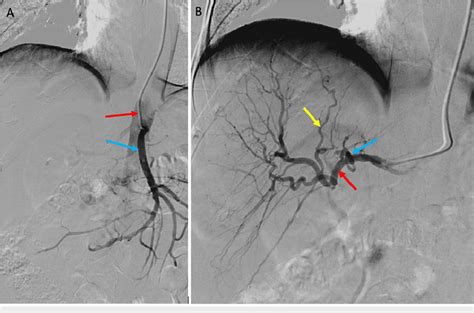 Fluoroscopic Image Digital Subtraction Angiography Showing Contrast