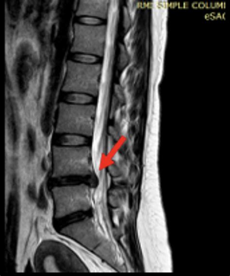 Deslizamiento Hernia Rayos X