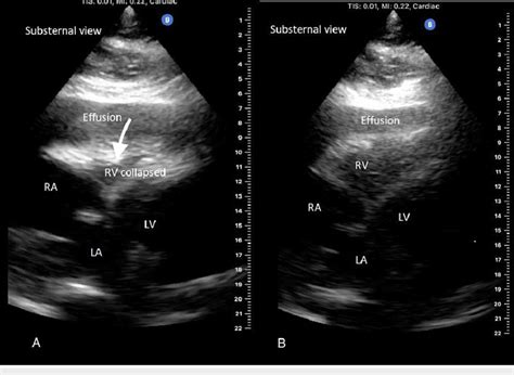 Bedside Echocardiography Bedside Echocardiography Using Butterfly IQ