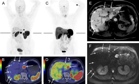 Maximal Intensity Projections A And C And PET CT B And D Scans With