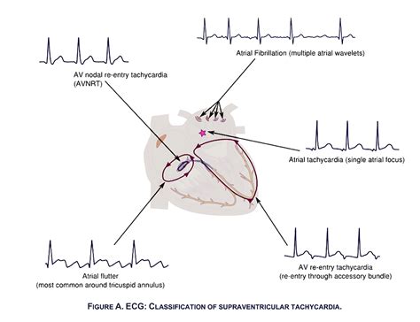 Ekg Interpretation For Step 2 How To Read An Ekg For Step 2