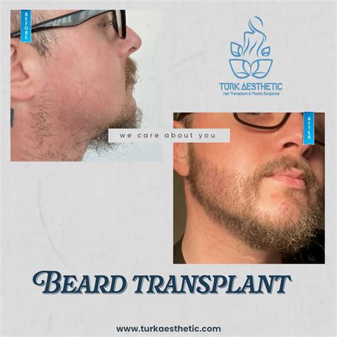 Beard Transplant In Turkey 6 Hours Turk Aesthetic