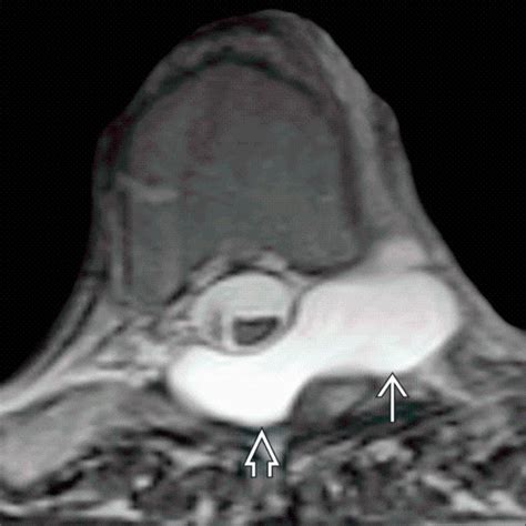 Lateral Meningocele Clinical Tree