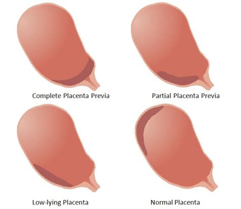 Placenta | Placenta praevia - Ontario Fetal Centre