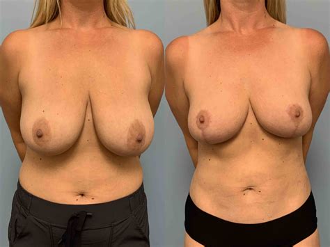 Breast Reduction Gallery Dr Paul Vanek