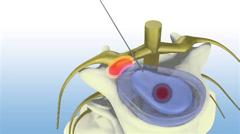 PLDD Percutaneous Laser Disc Decompression With Iccy 980 YouTube