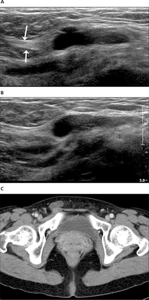 Sonography Of Various Cystic Masses Of The Female Groin Oh 2007 Journal Of Ultrasound In