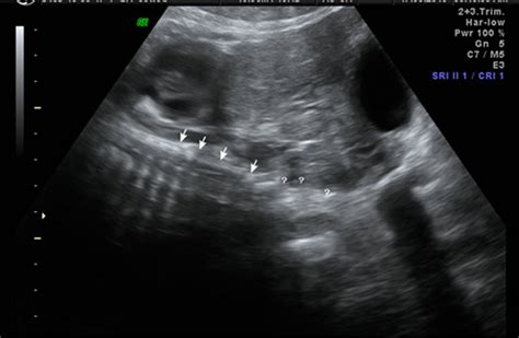 Prenatal Diagnosed Caudal Regression Syndrome