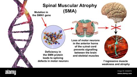 Atrophie musculaire spinale Banque de photographies et dimages à haute